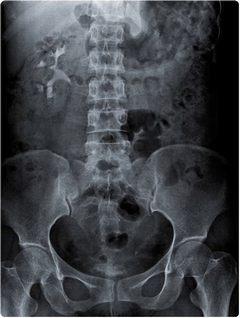 KUB Radiography .